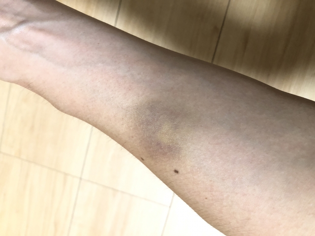 高齢者の皮下出血とは？老人性紫斑の特徴と正しい理解